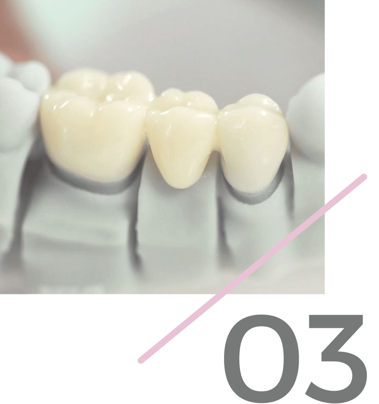 Paso 3: Restauración de zirconia entregada a su consultorio dental