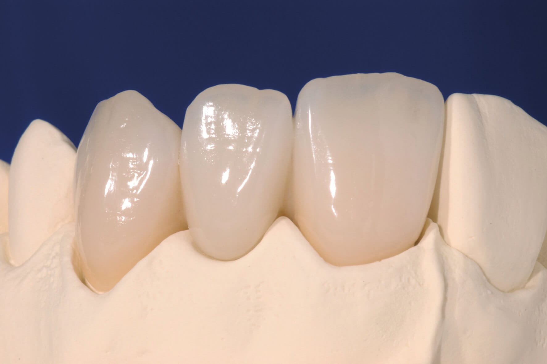 Custom zirconia dental bridge for replacing missing teeth by Rivfor Dental Lab