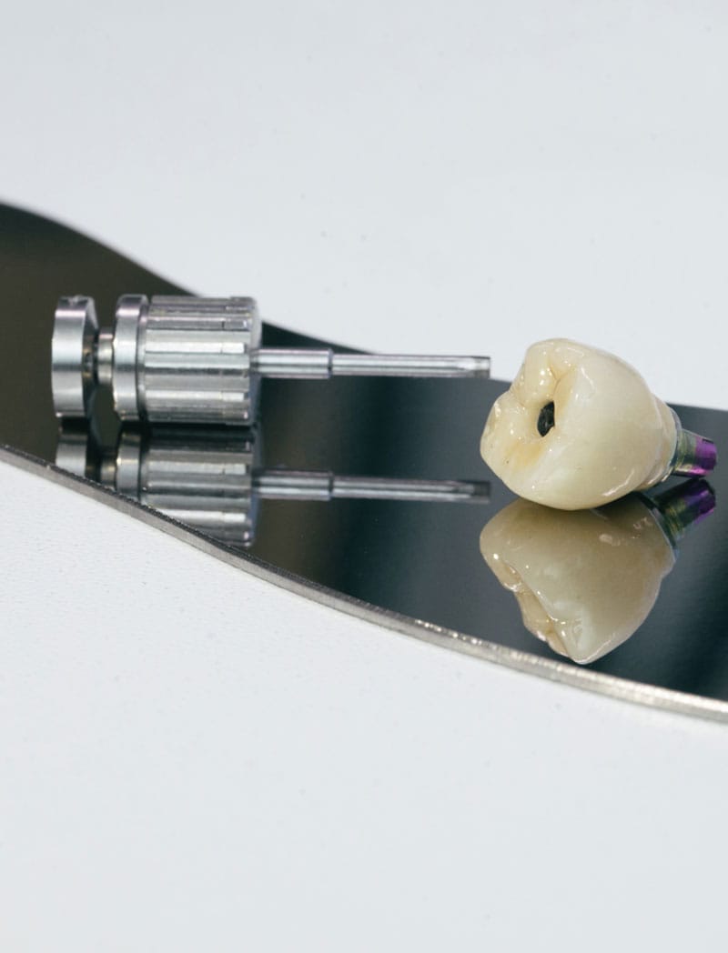 Precision zirconia dental implant restoration by Rivfor Dental Lab in Miami