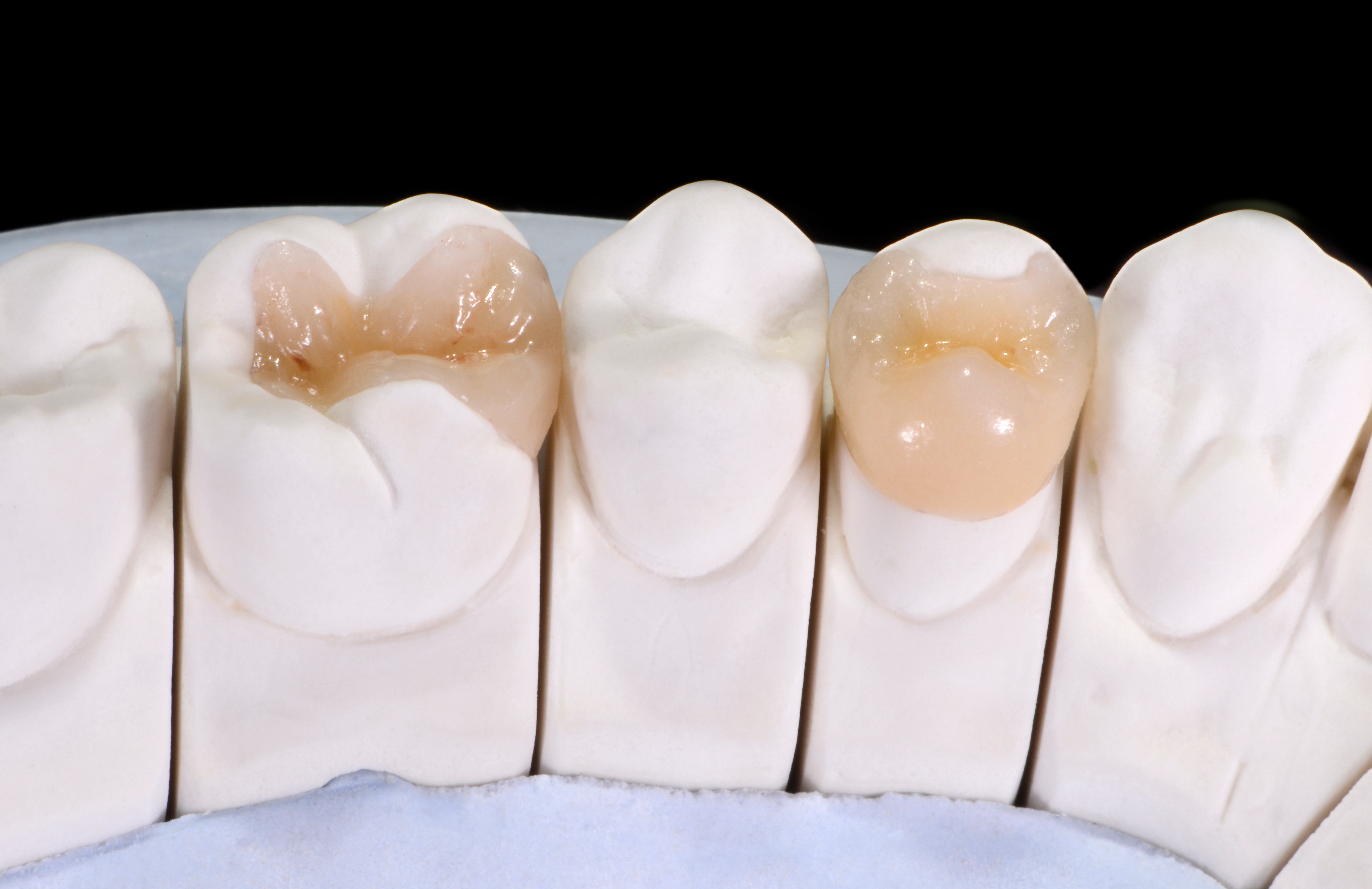 Zirconia dental inlays and onlays as a conservative tooth restoration by Rivfor Dental Lab